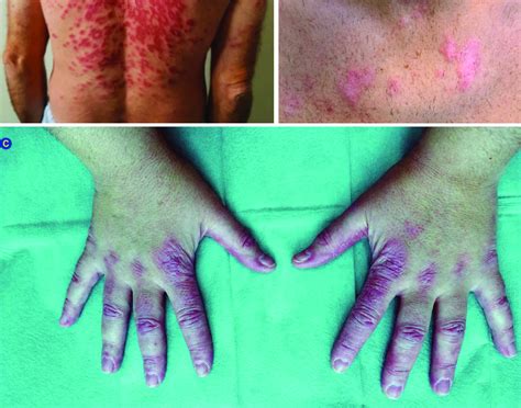 A Cutaneous Lupus Erythematosus Subacute Cutaneous Lupus