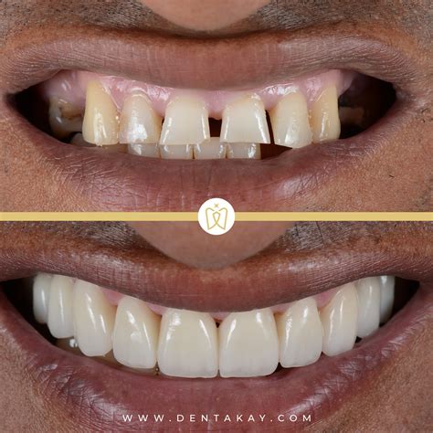 Hollywood Smile Before And After Dentakay