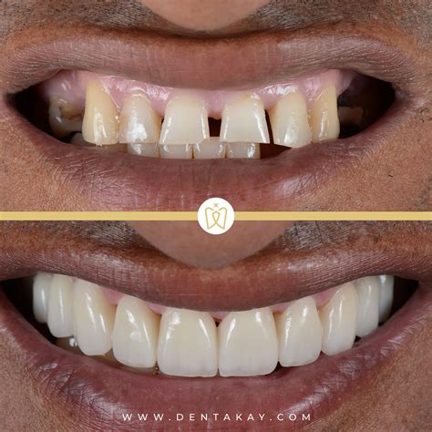 Hollywood Smile - dentakay.com