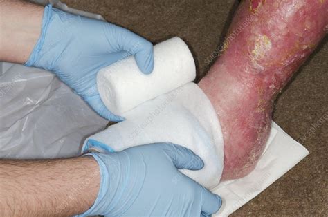 Infected Leg Ulcer Being Dressed Stock Image C0150341 Science
