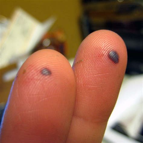Blood Blisters Causes Symptoms Treatment Pictures Prevention
