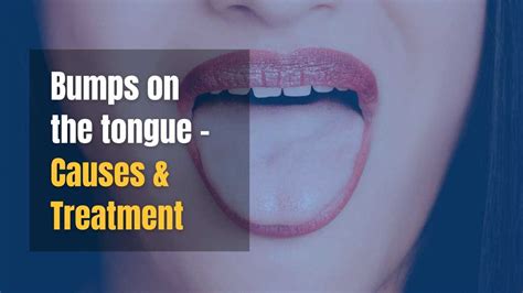 Bumps On Back Of The Tongue Causes And Treatments Wapomu Health