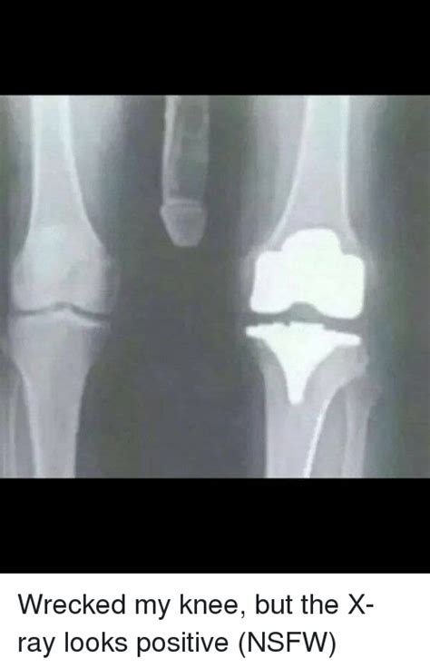 Funny Knee X Ray