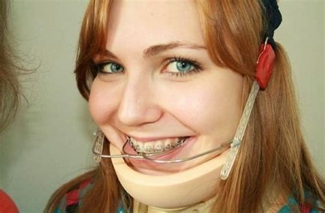 Pin By Shrood Burgos On Braces Dental Braces Braces Girls Brace Face