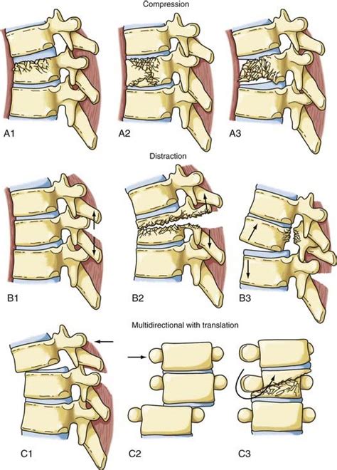 Diagnosis And Management Of Thoracic Spine Fractures Neupsy Key
