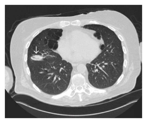 Chest Ct Scan Coronal View A And Axial Views B And C Showing A