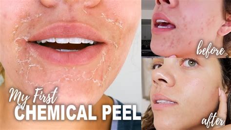 Peeling My Face Off Chemical Peel Youtube