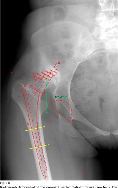 Figure 1 From Total Hip Arthroplasty With Shortening Subtrochanteric