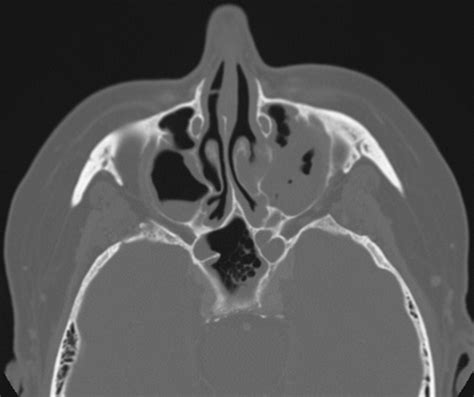 Case Pulmonary Mucormycosis Radiology