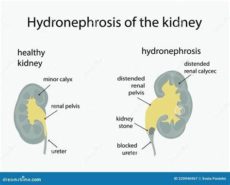 Hydronephrosis And Healthy Kidneys Urology Diagnosis Of Kidney