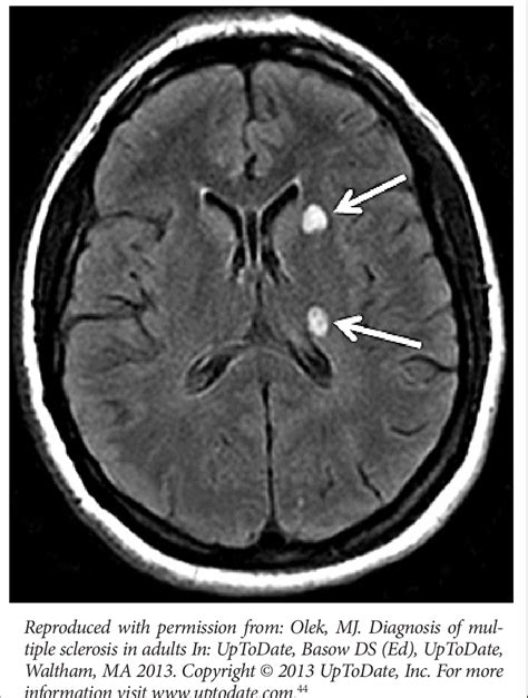 Mri Image Of 38 Year Old Woman With Multiple Sclerosis The Arrow