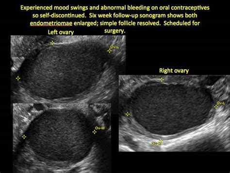 Imaging The Endometrioma And Mature Cystic Teratoma Mdedge Obgyn