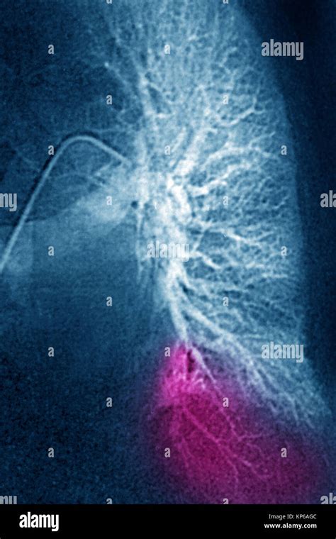 Infarto Pulmonar Angiografía Fotografía De Stock Alamy