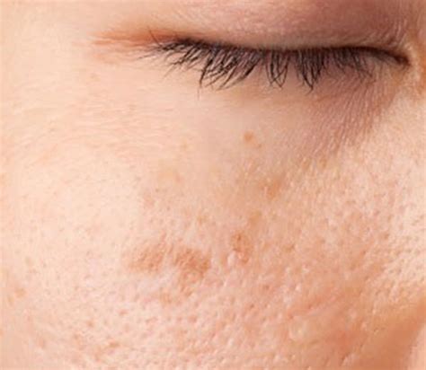 Protect Yourself From Sun Damage Causes Symptoms And Treatments Of Red
