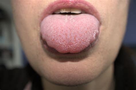 11 Swollen Tongue Causes What Does A Swollen Tongue Mean Ph