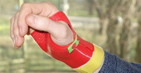 Innovative 3d Printing Is Offering A Helping Hand To Patients