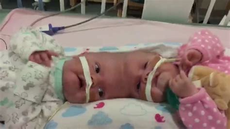 Rare Conjoined Twins Born Fused By Their Skulls Successfully Separated