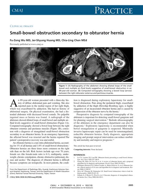 Pdf Small Bowel Obstruction Secondary To Obturator Hernia
