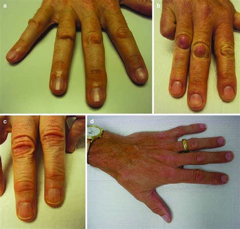 4 Dorsal Dupuytren Nodules A Dorsal Dupuytren Nodules Knuckle