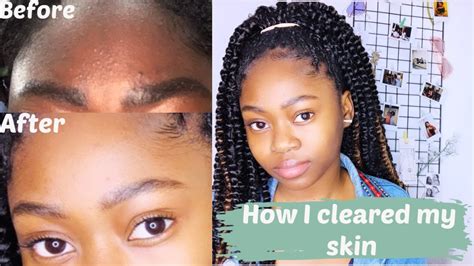 How To Get Rid Of Textured Skin Fast How I Cleared My Skin In A Week