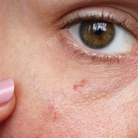Broken Capillaries And Facial Veins Drv Skin