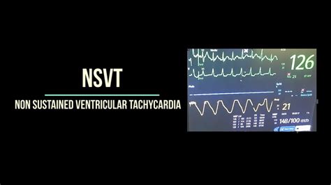 Nsvt Non Sustained Ventricular Tachycardia Youtube