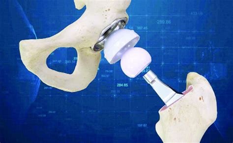 Revolutionary New Hip Replacement Surgery Daily Excelsior