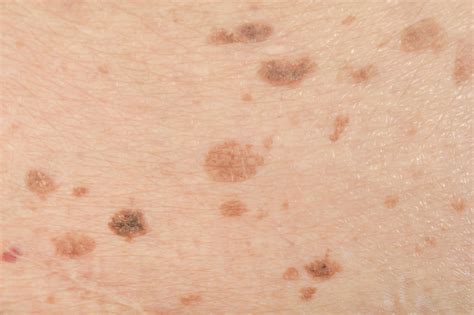 How To Remove Liver Spots And Birthmarks Procedure And Methods