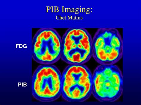 Ppt Alzheimers Disease Neuroimaging Initiative Adni Powerpoint