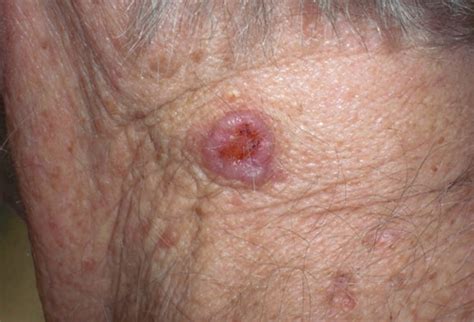 Can You Recognize Benign Skin Lesions From Cancerous Ones