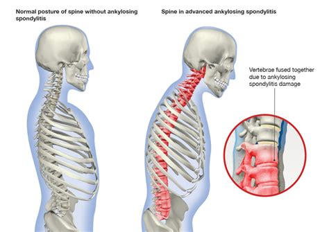 Ankylosing Spondylitis Causes Symptoms And Treatment Singapore