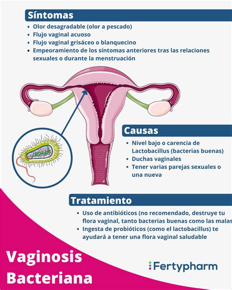 Causas De La Vaginosis Bacteriana Y Factores De Riesgo My Xxx Hot Girl