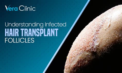 Infected Hair Transplant Follicles Vera Clinic