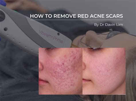 Professional Red Acne Scars Treatment Brisban Cutis Dermatology