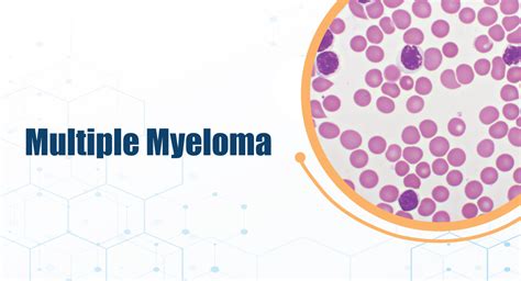 Multiple Myeloma The Indian Pharma