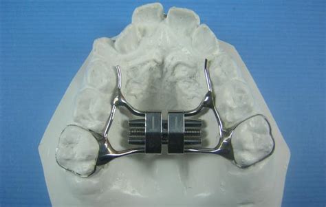 Standard Rpe Rapid Palatal Expander Accutech Orthodontic Laboratory