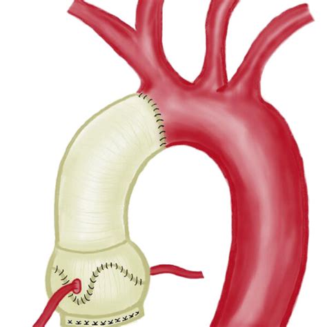Illustration Of Valve Sparing Aortic Root And Ascending Aorta