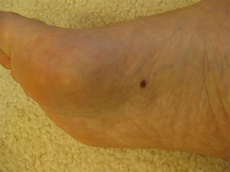 Skin Cancer On Foot Skin Check Houston Podiatrist Tanglewood Foot Specialists