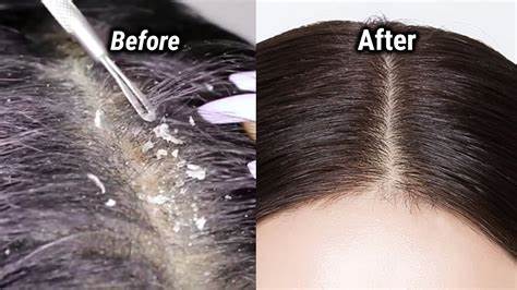 Does Dandruff Cause Hair Loss? Cures And Treatment