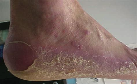 What You Should Know About Lichen Planus