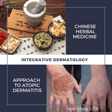 Treatment Of Atopic Dermatitis With Chinese Herbal Medicine Next