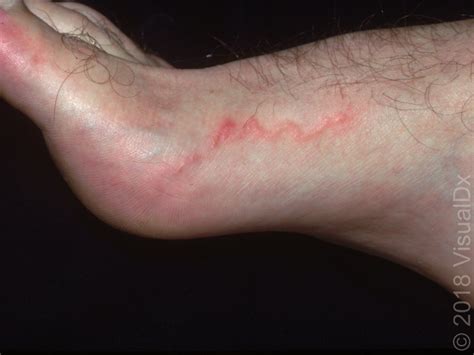 Image Iq Foot And Leg Lesions That Resemble A Red Line