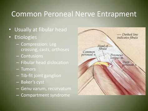 Ppt Nerve Entrapments In Runners Powerpoint Presentation Free