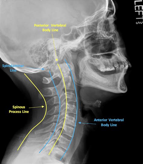 Subaxial Cervical Spine Plain Radiographs Radiology Key