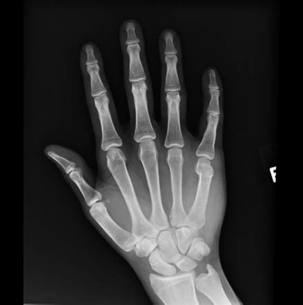 Boxer S Fracture Radiology Case Radiopaedia Org