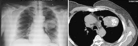 A Chest X Ray Showing A Mass Lesion In The Left Lung Upper Lobe B