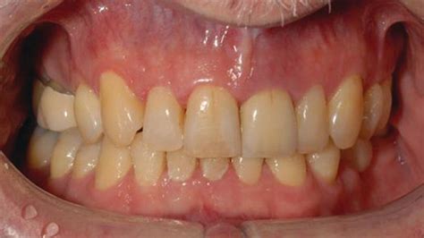 23 Peri‐implant Diseases Pocket Dentistry