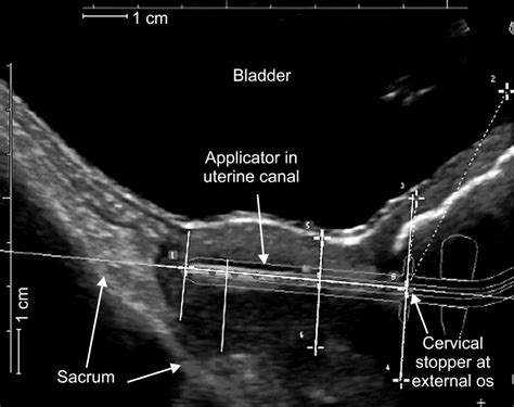 Sagittal Ultrasound View Of Uterus And Cervix With Treatment Applicator