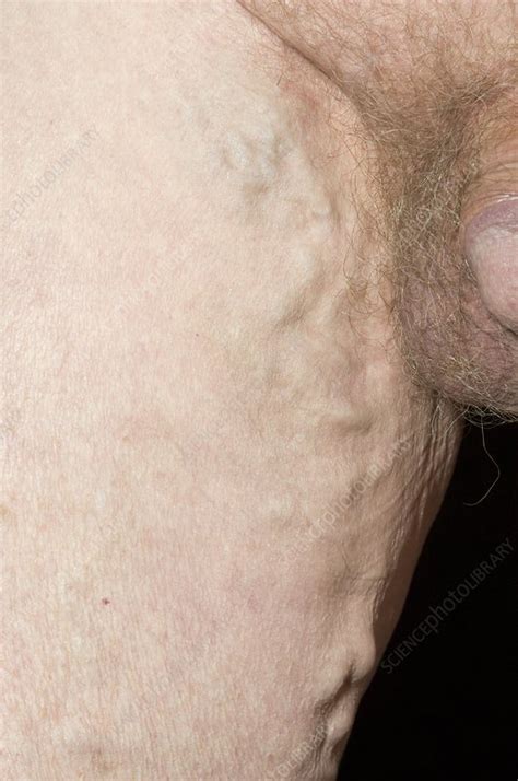 Varicose Veins In The Thigh Stock Image C0041228