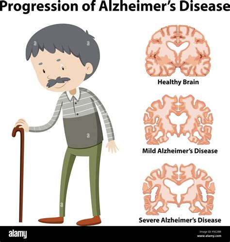 Progression Of Alzheimer S Disease Illustration Stock Vector Image And Art Alamy